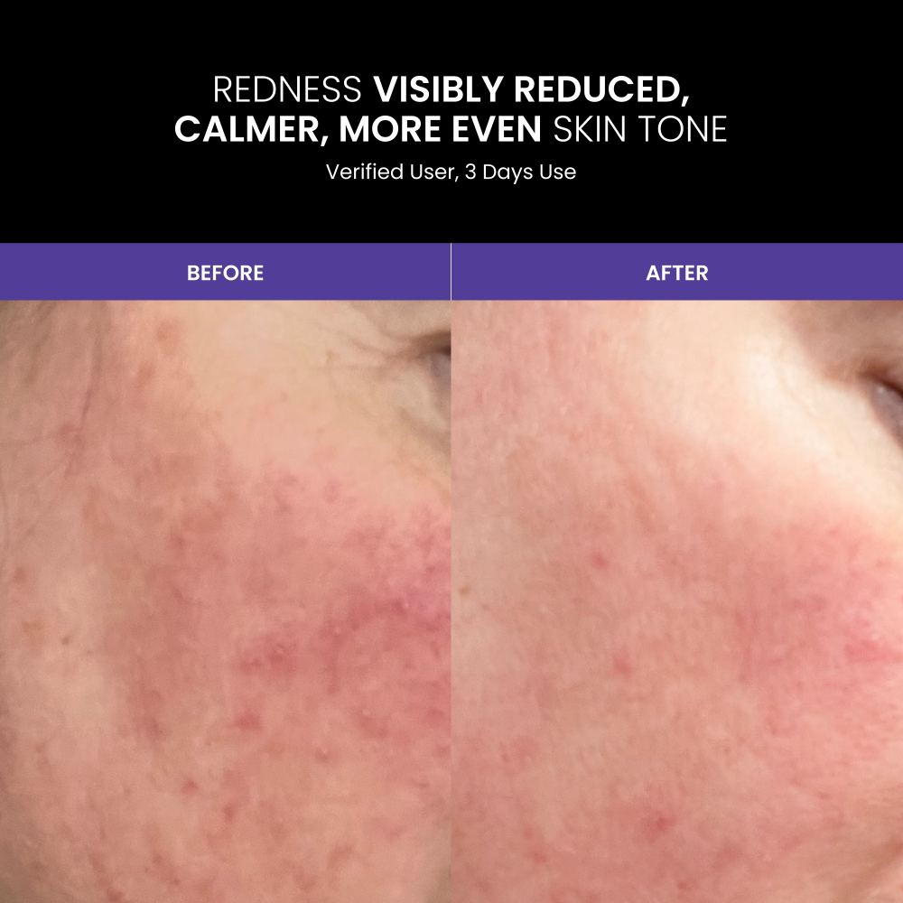 Lustre Renew Pro LED Face Mask