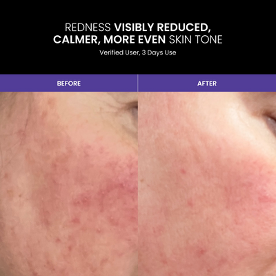 Lustre Renew Pro LED Face Mask